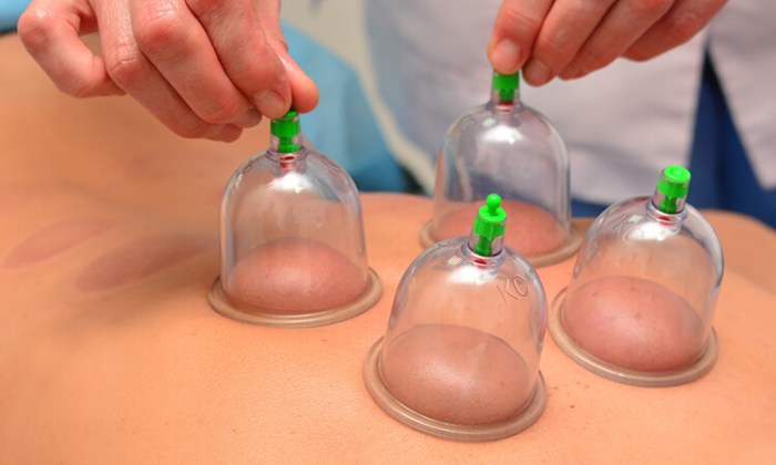 Cupping